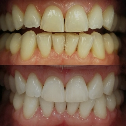 AuraGlow Zahnaufhellungspulver